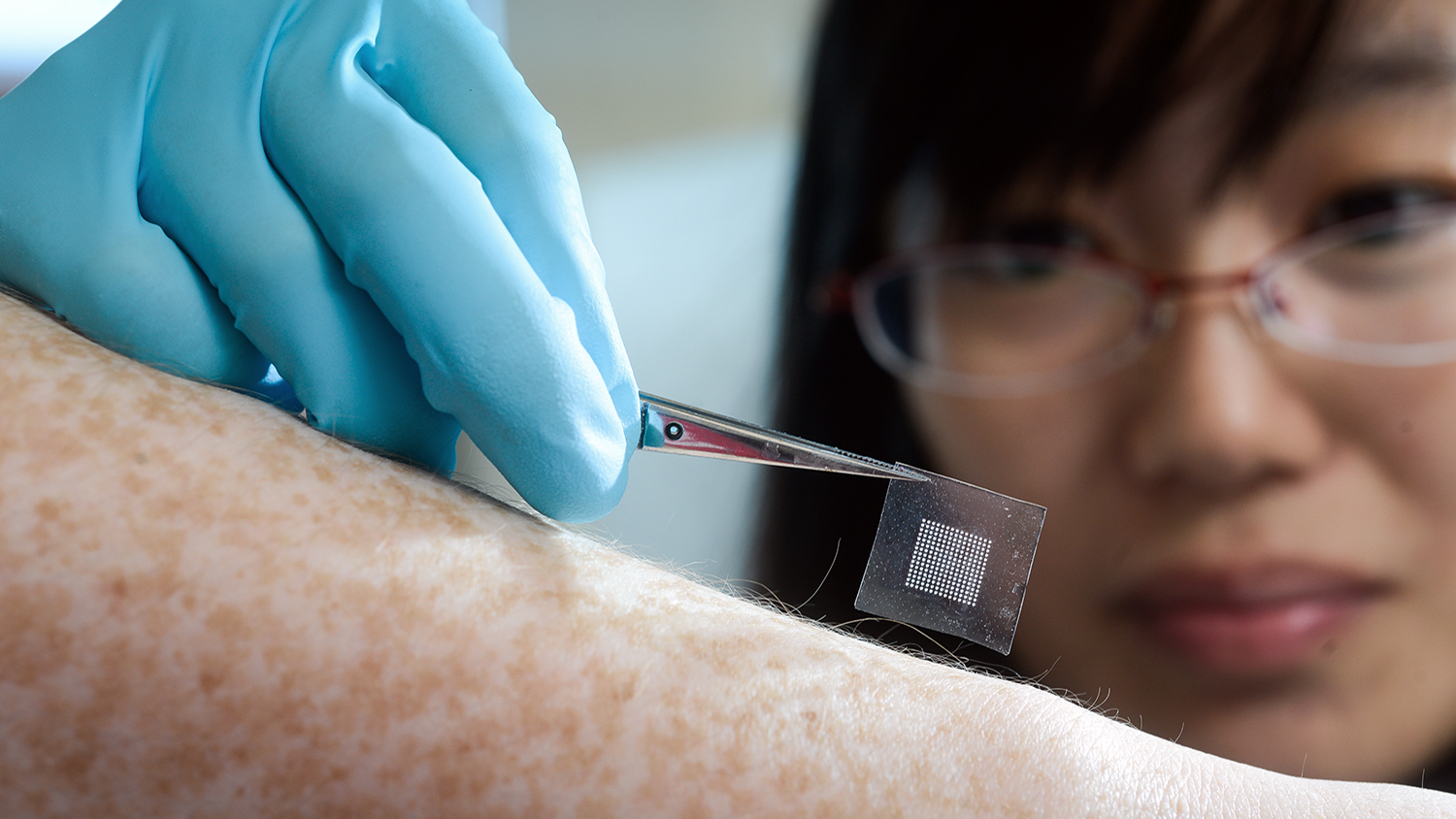 研究人员将胰岛素贴片应用于雀斑的前臂。
