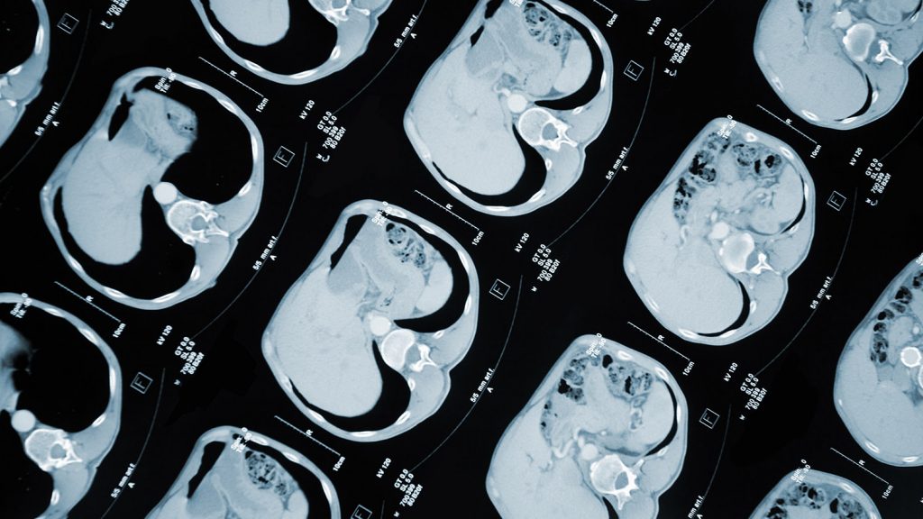 人腹部胃癌的CAT扫描