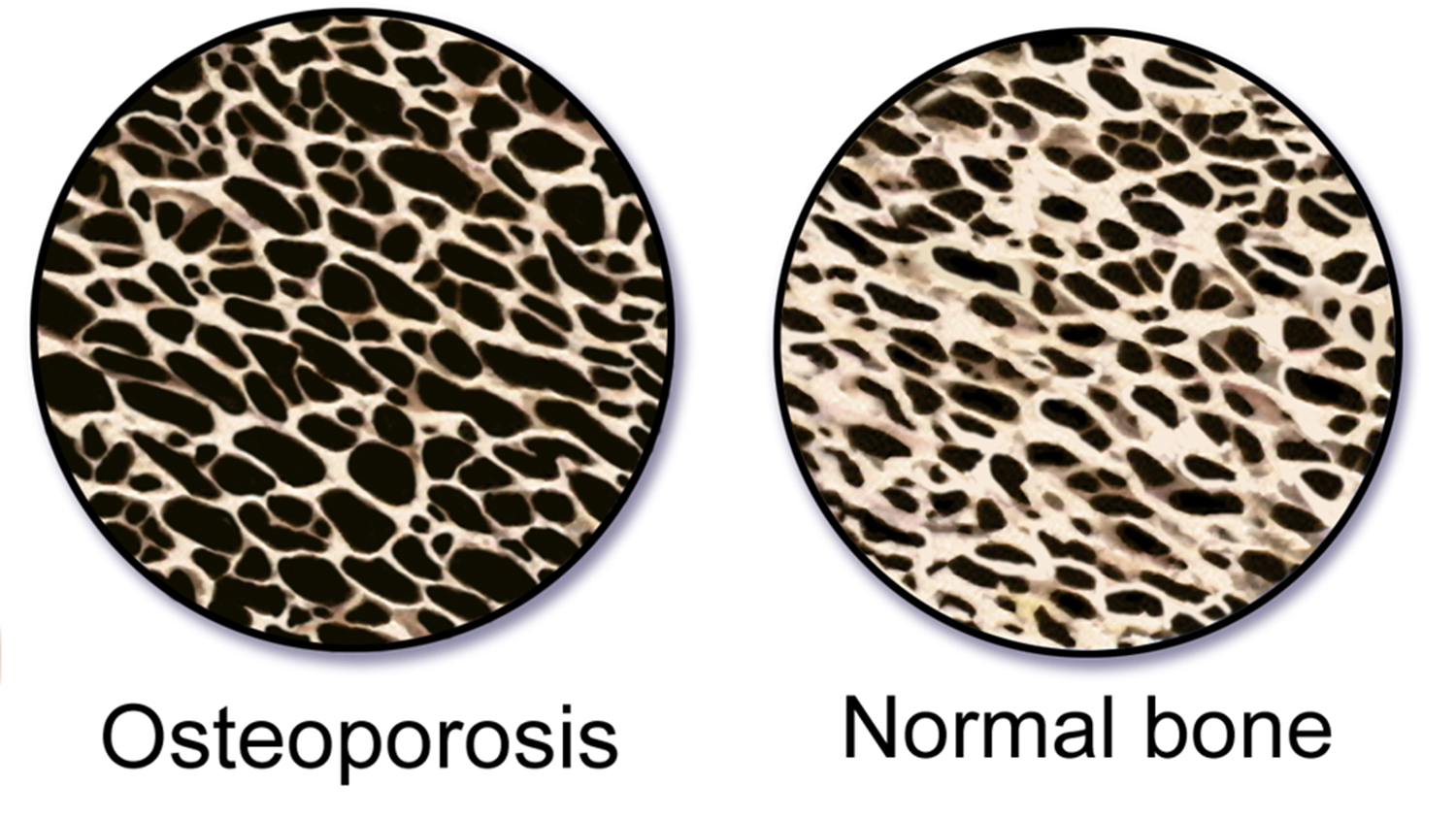 骨质疏松症与正常骨骼的对比图