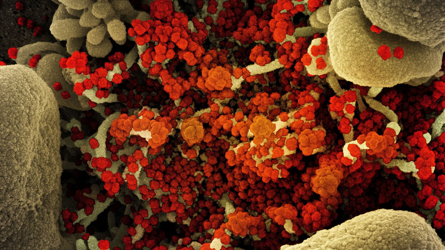 凋亡细胞（棕褐色）的着色扫描电子显微照片大量感染SARS-COV-2病毒颗粒（橙色）。